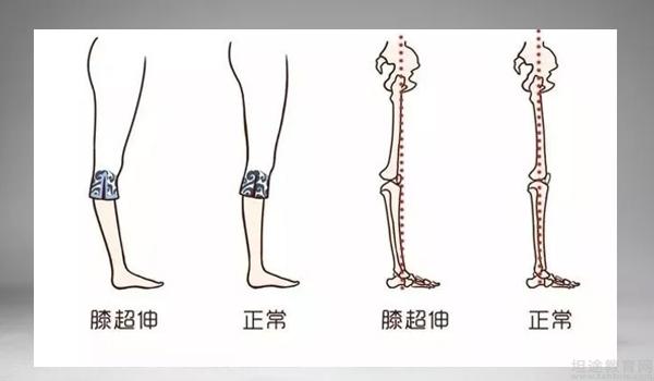 杭州坦途教育网 静园瑜伽   膝关节超伸是指膝关节过度伸直,膝盖向后